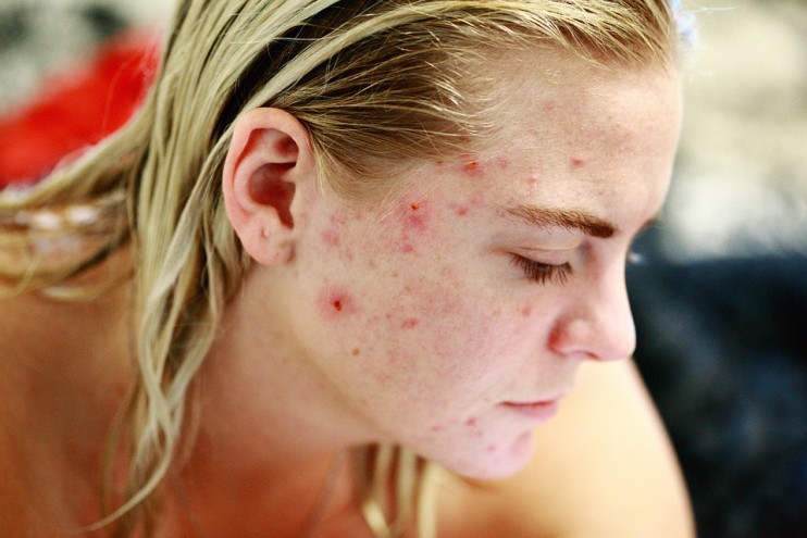 2 recettes de masques de visage pour traiter l'acné naturellement